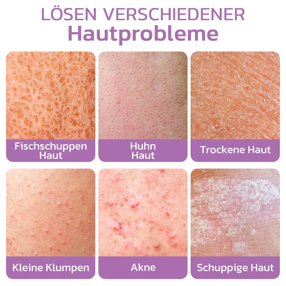 flysmus KP Keratose Gleichgewicht Radiergummi Krper Peeling